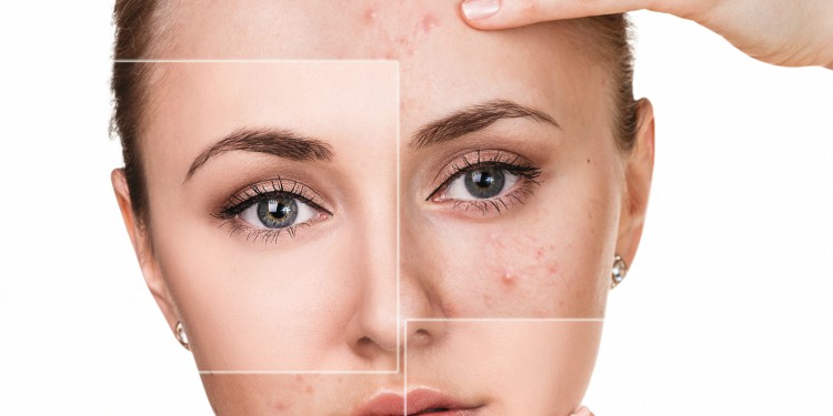 5 trucos que toda chica con piel grasa debe seguir